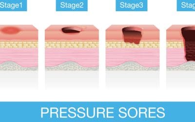 Unlocking the Advantages of Adhesive-Coated Polyurethane Films for NPWT Dressings